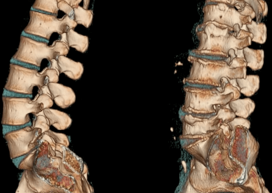 Enfermedad osteocondral