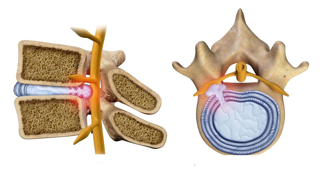 osteocondrosis torácica hernia espinal