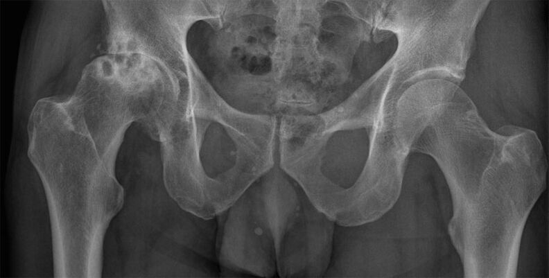 Articulación deformada de la cadera en la radiografía