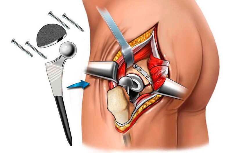 Colocación de una endoprótesis un enfoque quirúrgico para los problemas de cadera