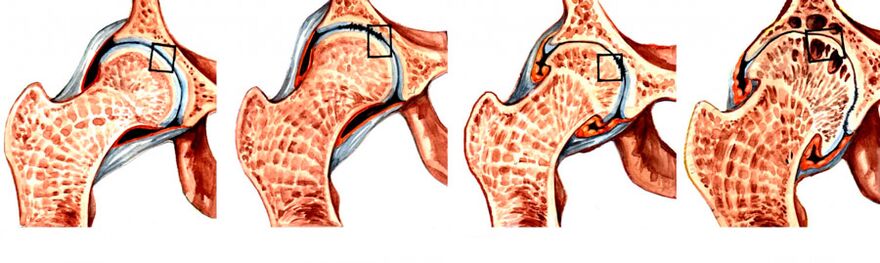El grado de desarrollo de la enfermedad de la articulación de la cadera. 