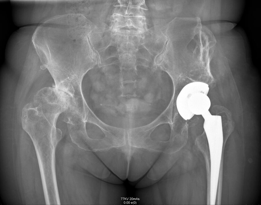 Radiografía de la articulación de la cadera después del reemplazo articular