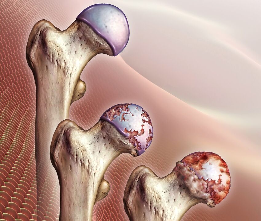 desarrollo de la enfermedad de la articulación de la cadera