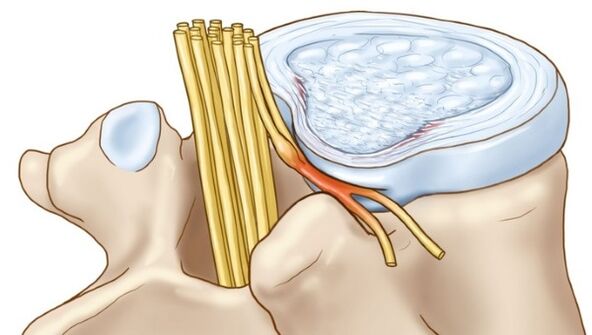 La osteocondrosis lumbar puede provocar complicaciones como la hernia intervertebral. 