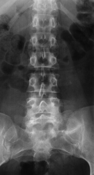 Para diagnosticar la osteocondrosis de la columna lumbar, se requiere un examen radiográfico. 