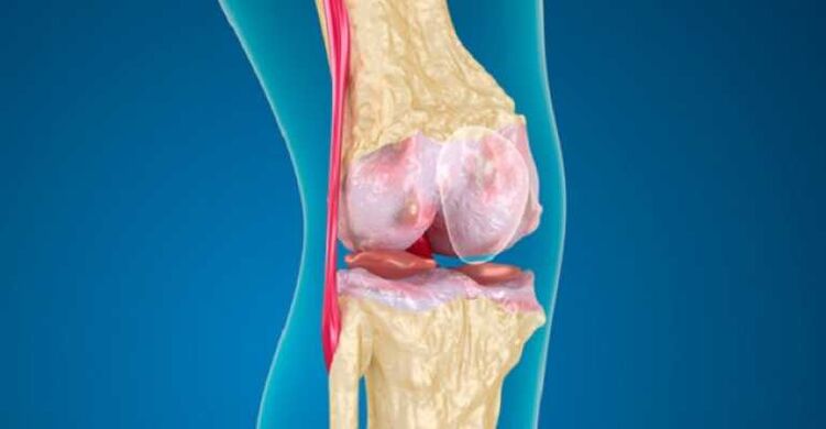 Artritis de la enfermedad de las articulaciones de la rodilla, lo que provoca daños en el cartílago articular